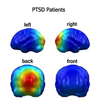 Areas of high (red) and low (blue) brain activity in a torture victim looking at emotionally-charged photographs  Credit: Claudia Catani